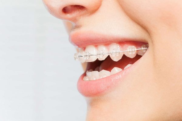 Thời gian niềng răng phụ thuộc vào độ tuổi cũng như tình trạng răng miệng của từng người