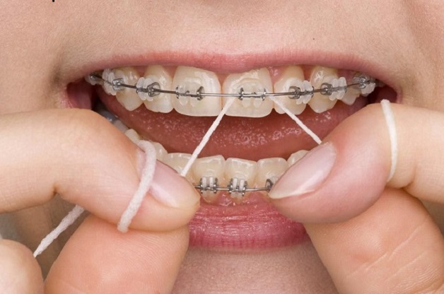Niềng răng là phương pháp hiệu quả giúp cải thiện những khiếm khuyết ở răng, tăng tính thẩm mỹ cho hàm răng cũng như đảm bảo chức năng ăn nhai.