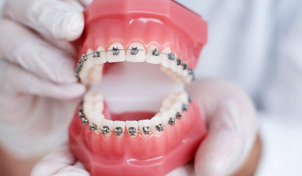 Niềng răng bằng mắc cài cố định là phương pháp chỉnh nha gắn cố định khí cụ niềng vào răng