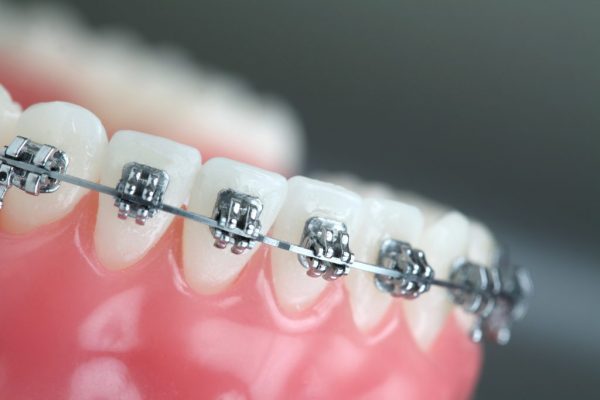 Phương pháp niềng răng bằng mắc cài kim loại