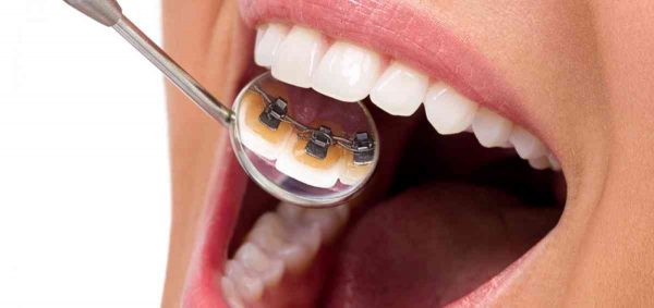 Phương pháp niềng răng bằng mắc cài mặt lưỡi