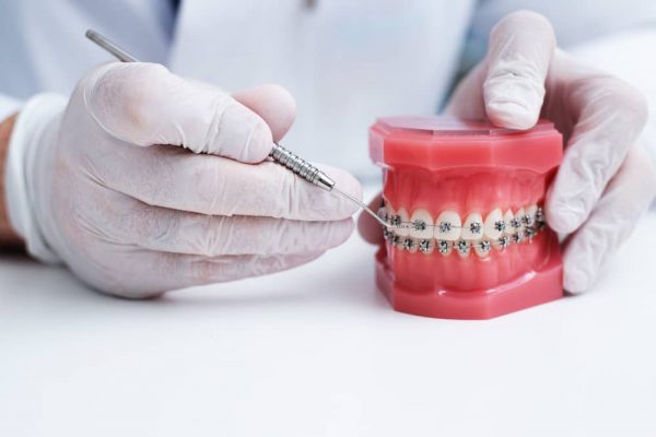 Mức giá niềng răng tại các cơ sở nha khoa phụ thuộc vào rất nhiều yếu tố