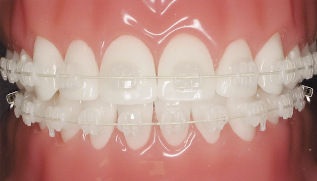 Niềng răng mắc cài sứ giá bao nhiêu còn phụ thuộc vào loại niềng răng như mắc cài sứ thường hoặc mắc cài sứ tự buộc