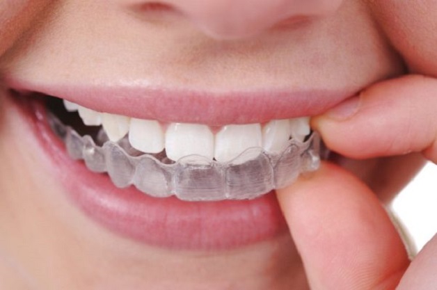 Niềng răng hết bao nhiêu tiền