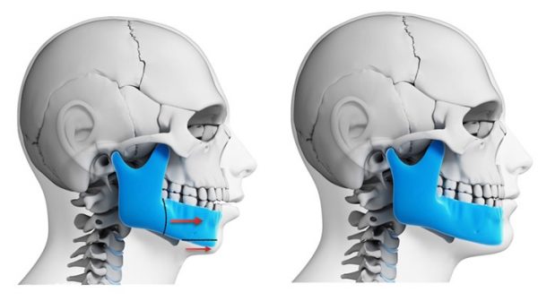 Phẫu thuật giúp điều chỉnh các vấn đề lệch, khiếm khuyết ở hàm để bảo toàn chức năng nhai và giúp khuôn mặt cân đối hơn
