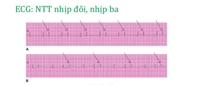 Nhịp tim bị rối loạn có những loại nào?