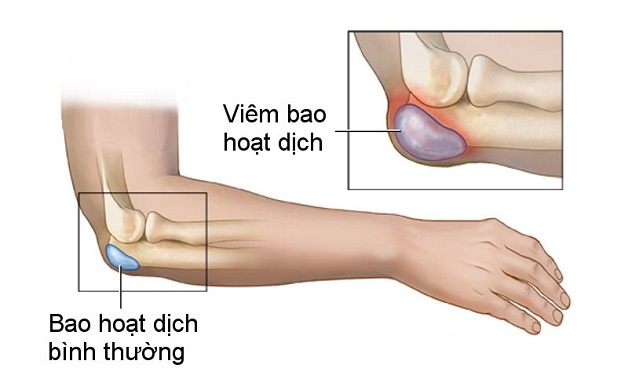 siêu âm khớp khuỷu