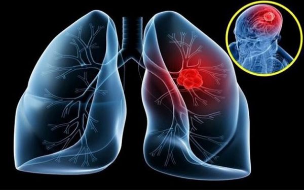 Triệu chứng ung thư phổi là mối quan tâm của nhiều người