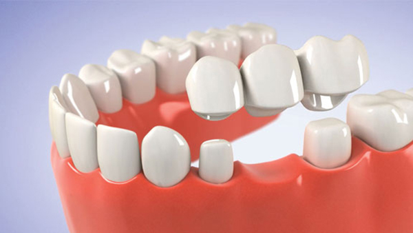 Trồng răng cố định bằng phương pháp bắc cầu răng sứ