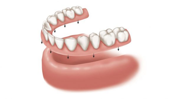 Phương pháp trồng răng nanh bằng hàm giả tháo lắp