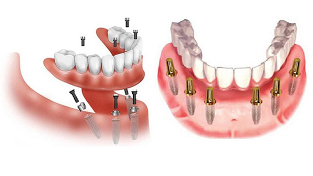 Implant hiện là phương pháp trồng răng toàn hàm khá phổ biến.