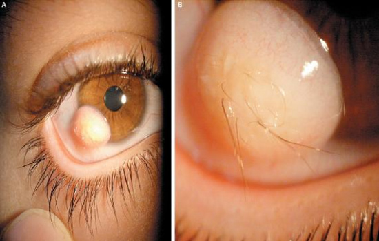 U bì kết giác mạc là căn bệnh về mắt cần phải chú ý và theo dõi sát sao