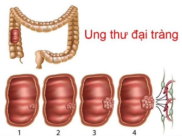 Ung thư đại tràng là bệnh lý đường tiêu hóa ác tính
