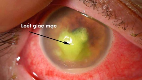 viêm loét giác mạc