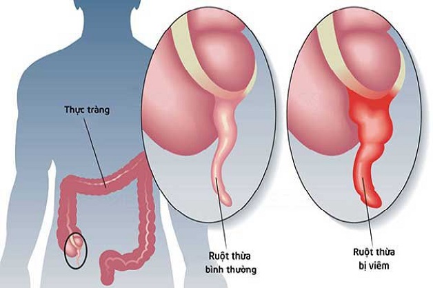 cắt ruột thừa ngược dòng