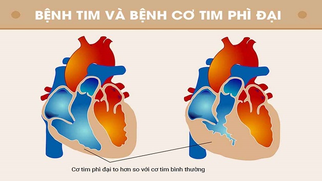 bệnh cơ tim phì đại là gì?