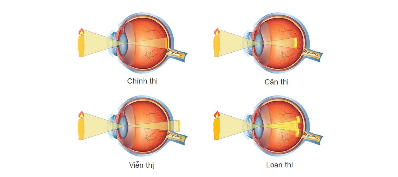 các loại tật khúc xạ thường gặp