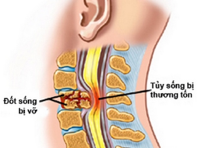 chấn thương cột sống có thể gây bệnh lý tủy sống