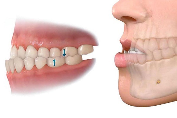 Móm răng có thể hình thành do di truyền hoặc trong thói quen ăn uống, vệ sinh răng miệng hằng ngày