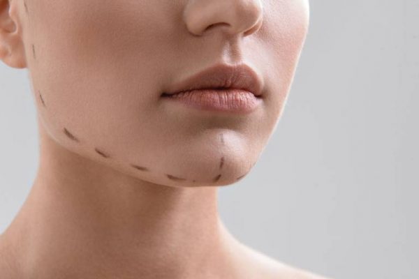 Chi phí phẫu thuật hàm hô có sự chênh lệch lớn giữa các cơ sở nha khoa hiện nay