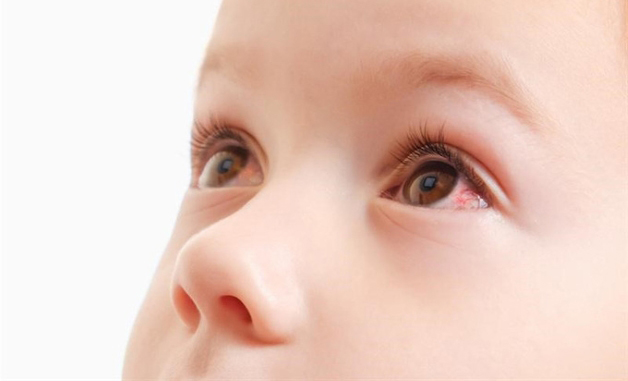 đau mắt đỏ ở trẻ nhỏ