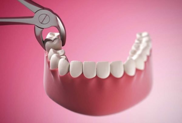 Giá nhổ răng hàm ở mỗi phương pháp sẽ có sự khác biệt