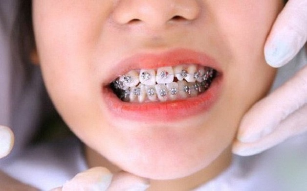 Giá niềng răng hô ở mỗi phương pháp sẽ có sự chênh lệch khác nhau
