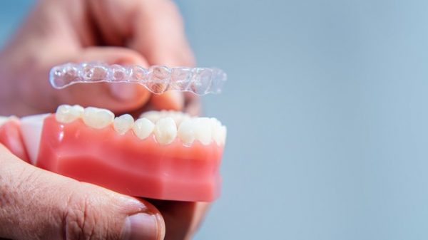 Niềng răng không mắc cài sử dụng khay niềng trong suốt được thiết kế dựa trên cấu trúc, hình dạng của răng gặp khiếm khuyết