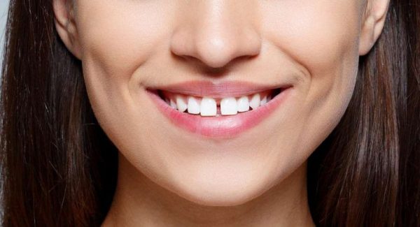 Hiên tượng răng trên cùng một hàm mọc xa nhau, mọc không đều hoặc không đủ răng tạo ra kẽ hở gọi là răng thưa