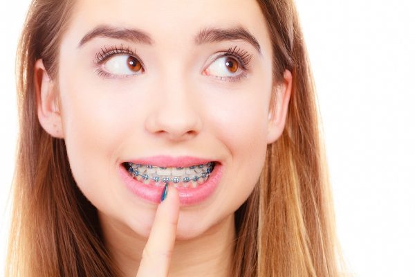 Mức giá niềng răng thưa ở mỗi cơ sở nha khoa là khác nhau, tùy thuộc vào từng phương pháp bạn lựa chọn