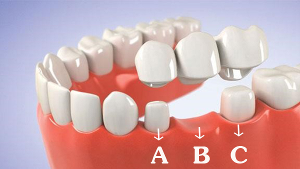 Giá trồng răng sứ dao động trong khoảng từ vài triệu đồng/răng