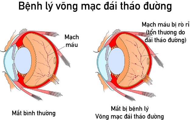 tổn thương mạch máu nhỏ ở bệnh nhân tiểu đường
