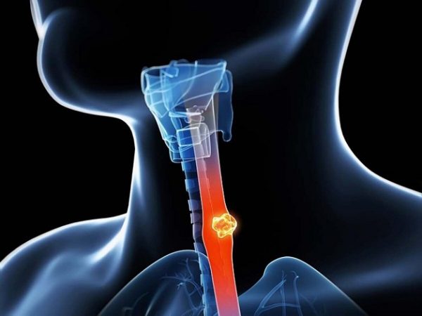 Hóa chất điều trị ung thư thực quản
