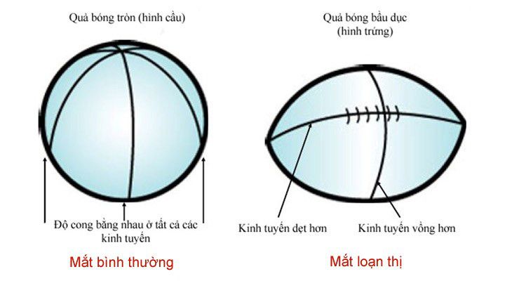 loạn thị có tăng độ không