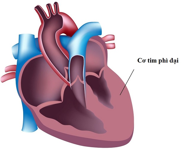 Nguyên nhân gây suy tim dạng cấp tính