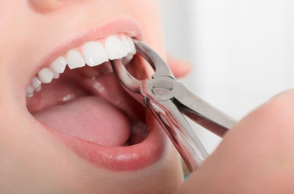 nhổ răng hết bao nhiêu tiền