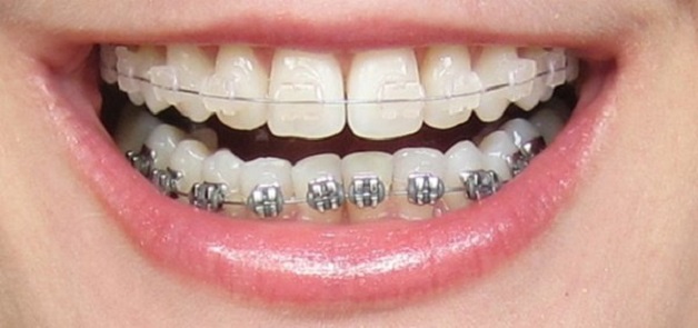 Niềng răng móm không chỉ khắc phục tình trạng móm hiệu quả mà còn có tác dụng cải thiện khớp cắn, ngăn ngừa các bệnh lý ảnh hưởng tới sức khỏe răng miệng