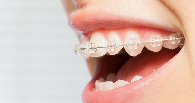 Trên thực tế, niềng răng sứ giá bao nhiêu còn tùy thuộc vào phương pháp thực hiện