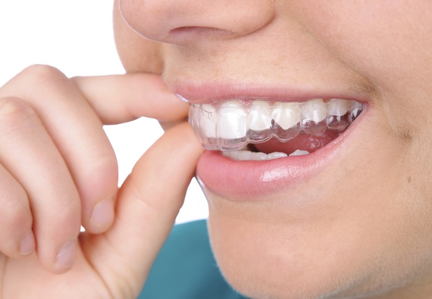 Niềng răng trong suốt giúp đảm bảo thẩm mỹ giúp người niềng có thể tự tin, giao tiếp ngay cả khi đang chỉnh nha