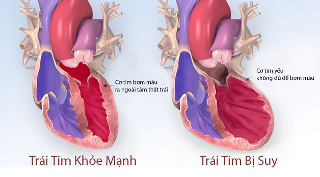 suy tim sung huyết là gì?