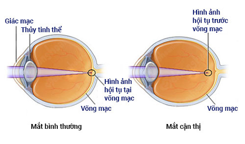 hình ảnh hội tụ ở võng mạc người cận thị