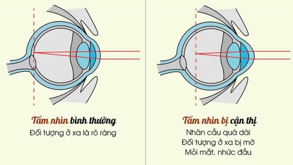 thoái hóa võng mạc cận thị