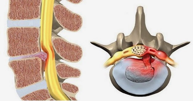 thoát vị đĩa đệm chèn ép gây bệnh lý tủy sống