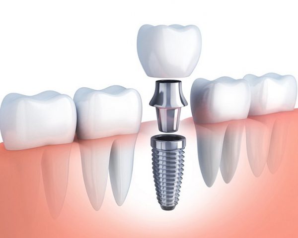 Với thắc mắc trồng răng giá bao nhiêu, tùy vào phương pháp trồng răng sẽ có mức chi phí khác nhau