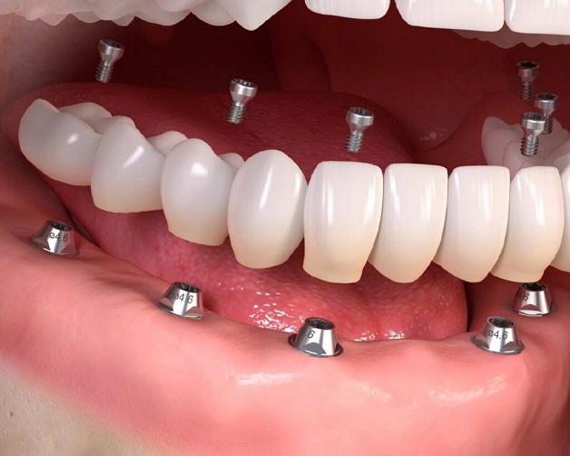 Với thắc mắc trồng răng hàm giá bao nhiêu, mỗi phương pháp trồng răng sẽ có mức chi phí riêng