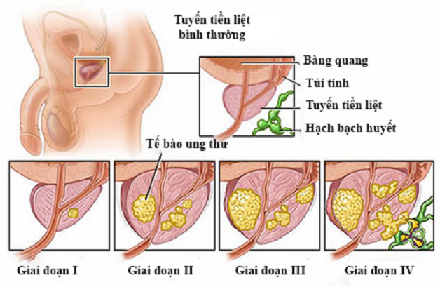 Ung thư tuyến tiền liệt chữa được hay không tùy thuộc vào giai đoạn phát hiện bệnh