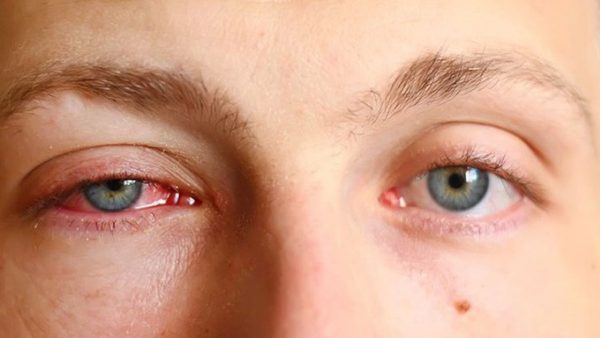 viêm kết mạc cấp tính