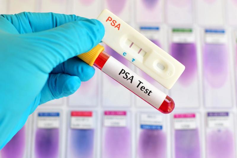 Chỉ cố PSA là thước đo phổ biến để phát hiện ung thư tuyến tiền liệt