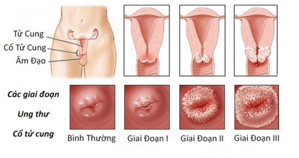 Giai đoạn phát triển của HPV ung thư cổ tử cung