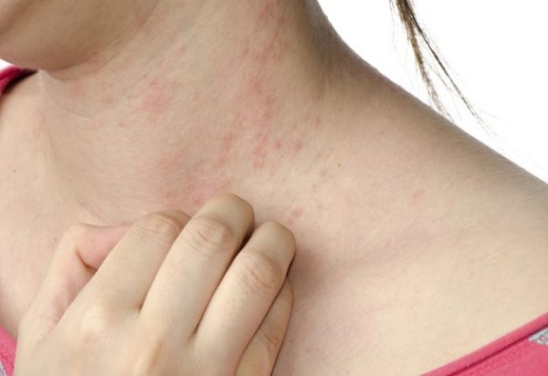 Ngứa ngáy nổi mề đay cũng là dấu hiệu ung thư gan cần lưu ý